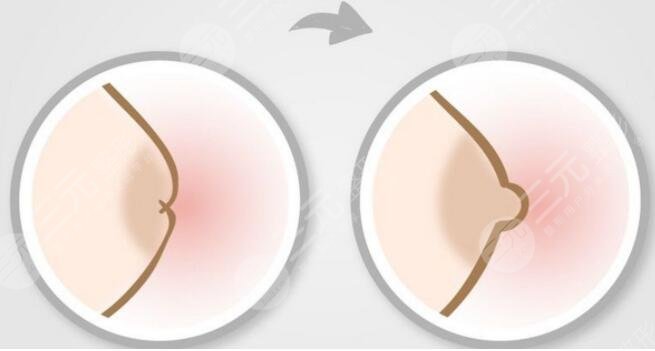 乳頭內(nèi)陷怎么辦？手術(shù)矯正方法又有！日常生活怎么正確護(hù)理胸部？