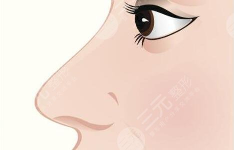 鼻尖整形大概多少錢一次2023？鼻尖整形mz方式、恢復(fù)時間、手術(shù)須知！