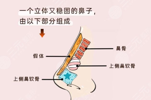 自體軟骨隆鼻好嗎?