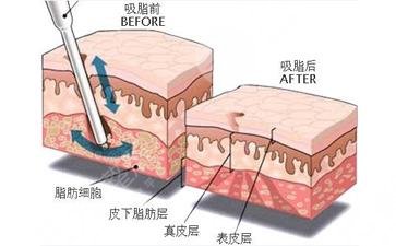 360度吸脂減肥價格是多少?