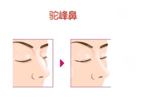 駝峰鼻矯正術(shù)手術(shù)多少錢??