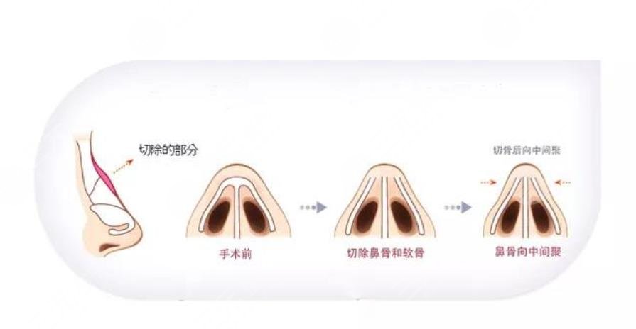 駝峰鼻矯正術(shù)手術(shù)多少錢??