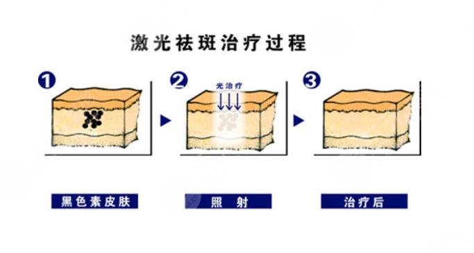 臉上的色斑怎么去掉？