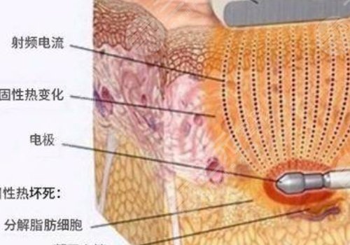 鐳射溶脂的危害有哪些？