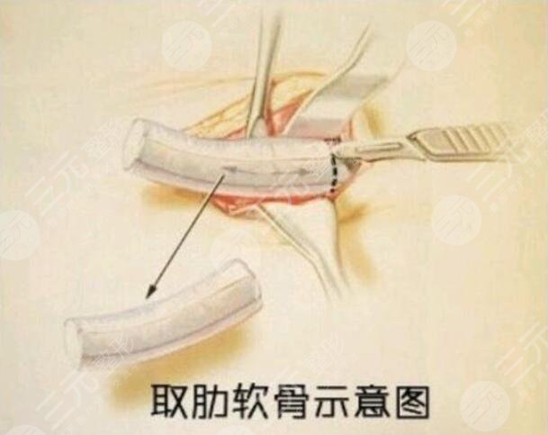 肋軟骨隆鼻的注意事項(xiàng)