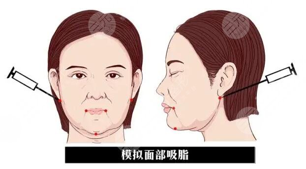 臉部吸脂多少錢2023收費明細(xì)一覽！真的會有效果嗎？怎么避坑？