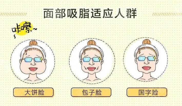 臉部吸脂多少錢2023收費明細(xì)