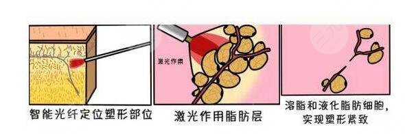 臉部吸脂術(shù)后要注意什么？