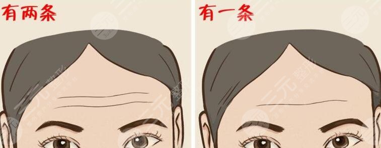 抬頭紋是什么?