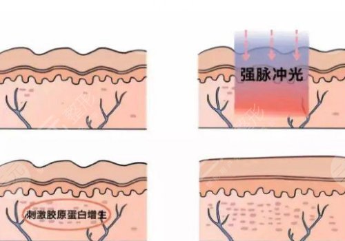 激光去疤痕需要幾次才能徹底消除？