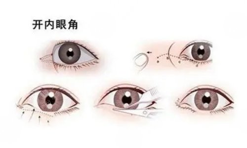 影響開(kāi)內(nèi)眼角手術(shù)價(jià)格的因素有哪些?