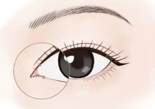 開(kāi)內(nèi)眼角一般多少錢?