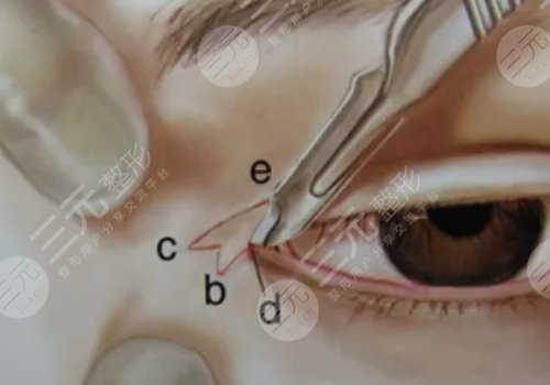 影響開(kāi)內(nèi)眼角手術(shù)價(jià)格的因素有哪些?