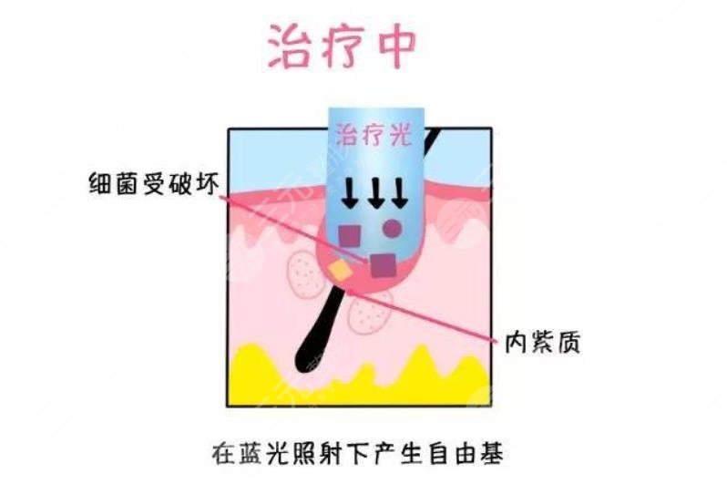 祛痘印痘坑好的方法有哪些？