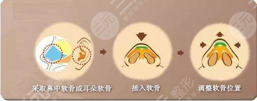 自體軟骨隆鼻效果怎?么樣?