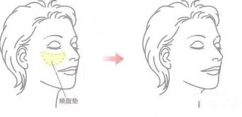 去頰脂墊的注意事項