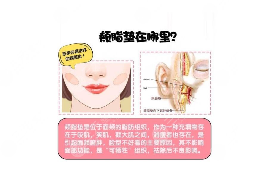 去頰脂墊的原理?是什么?