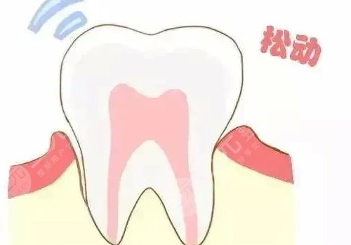 牙齒松動(dòng)有什么辦法恢復(fù)?