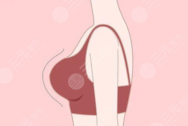 隆胸