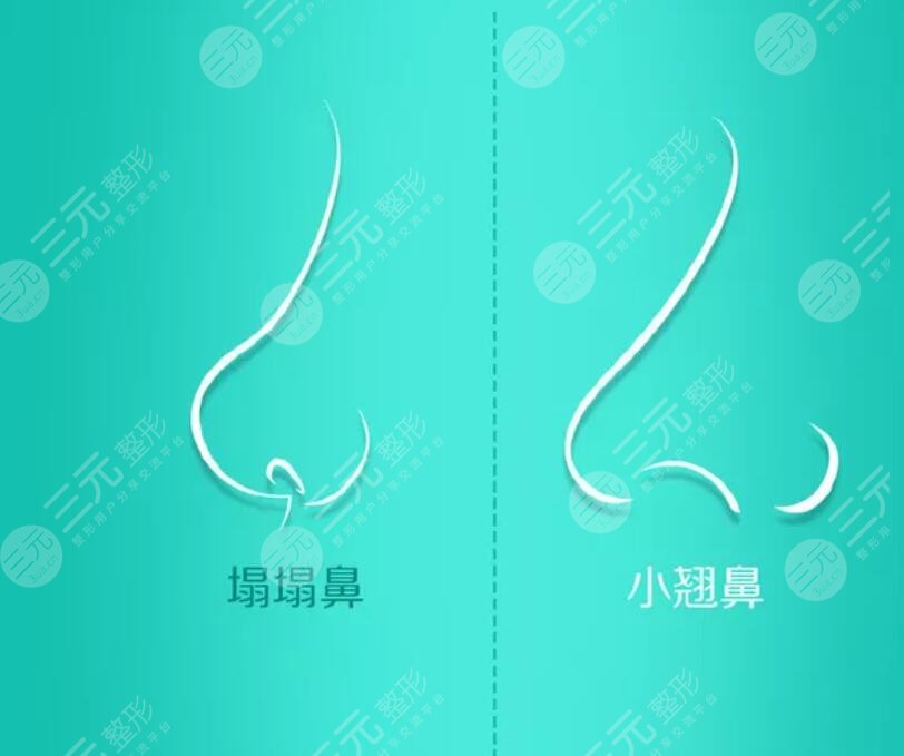 鼻子整形后要注意什么？