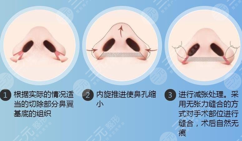 鼻翼縮小的方法?有幾種?