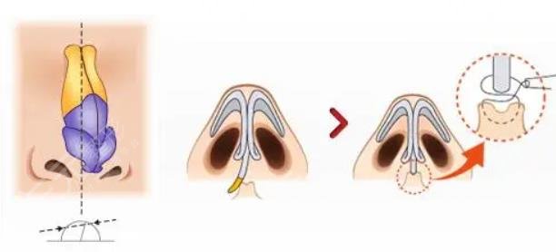 鼻翼縮小的方法?有幾種?