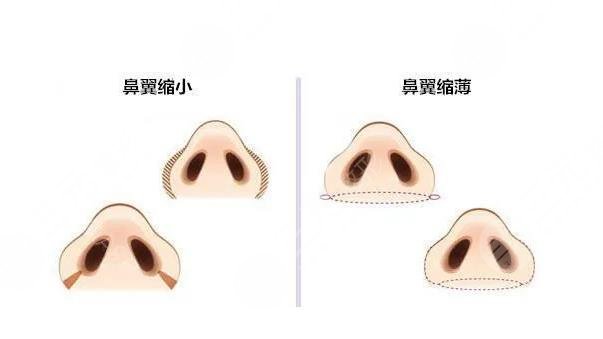 鼻翼縮小的方法?有幾種?