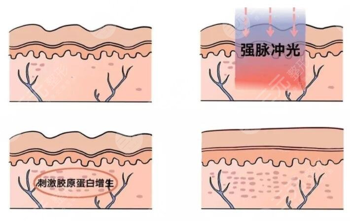 鐳射凈膚的注意事項(xiàng)有什么？