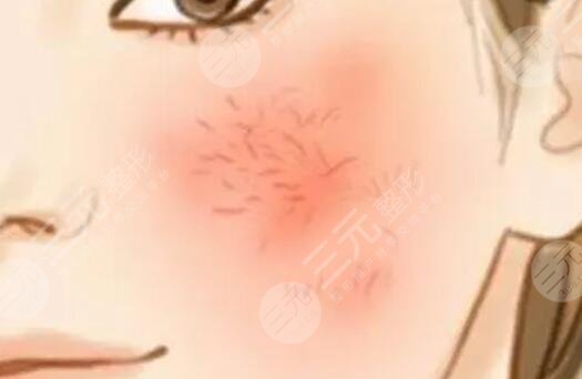 去紅血絲