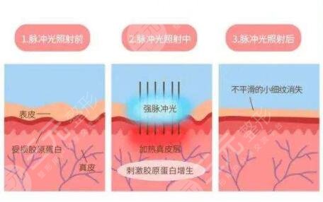 鐳射激光嫩膚效果好嗎?