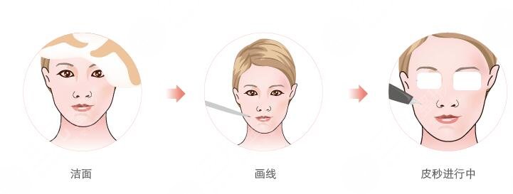 鐳射激光嫩膚術(shù)后注意事項(xiàng)
