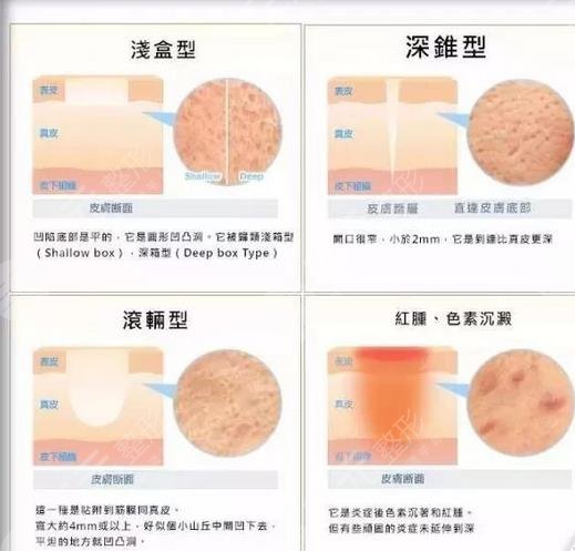 激光去痤瘡注意事項(xiàng)有哪些?
