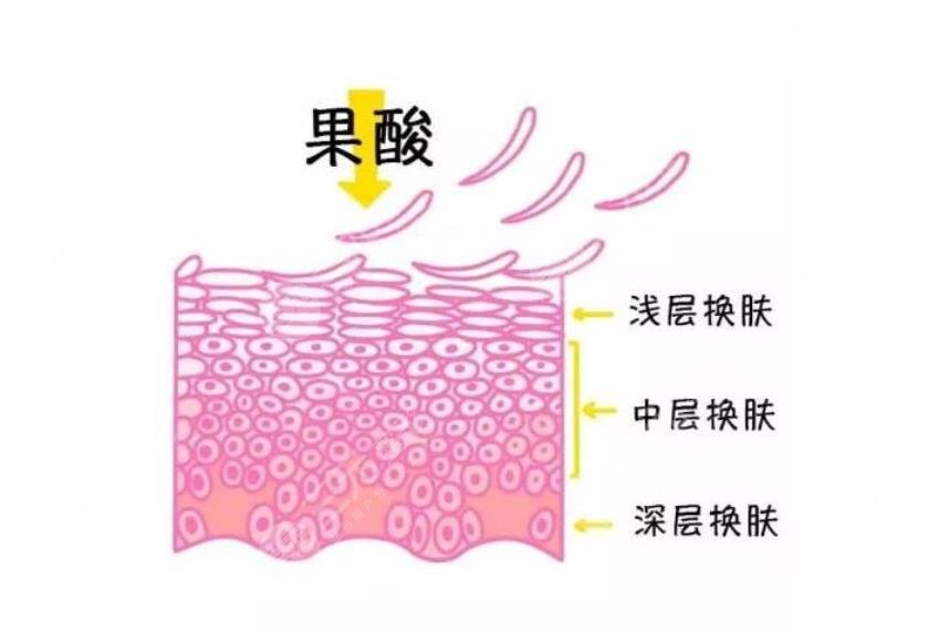 果酸煥膚去痘印有哪些優(yōu)勢(shì)?