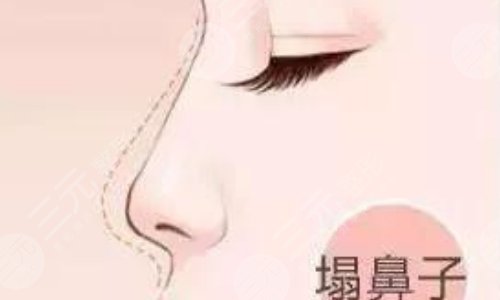 奧美定隆鼻有什么副作用？