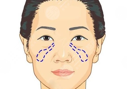 蘋果肌斷層是什么原因？