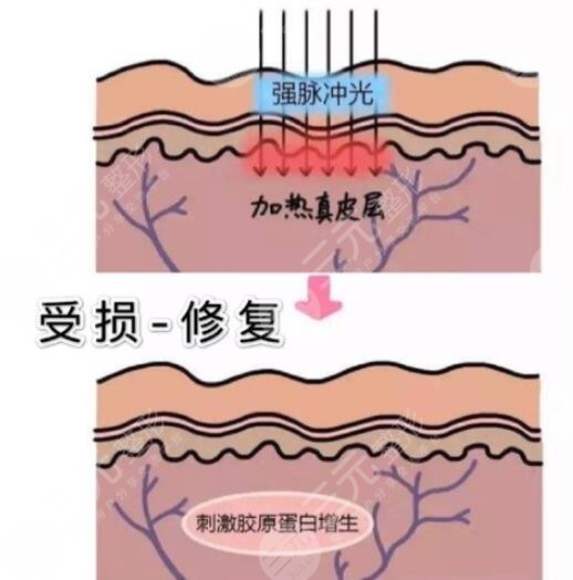 鐳射激光嫩膚原理