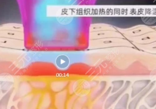 熱瑪吉全臉做一次多少錢？