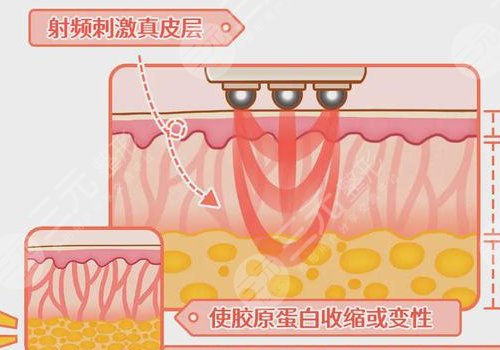 熱瑪吉全臉做一次多少錢？