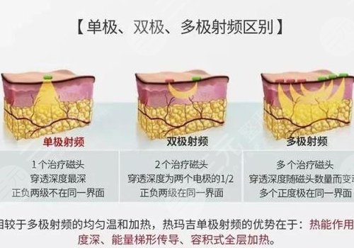 深藍(lán)射頻和熱瑪吉的區(qū)別有哪些？