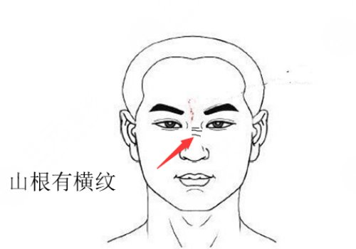 山根有橫紋是怎么回事？