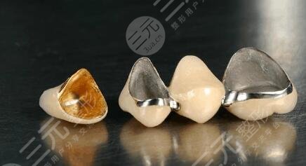 鈦合金烤瓷牙套價(jià)格多少錢一顆2023？