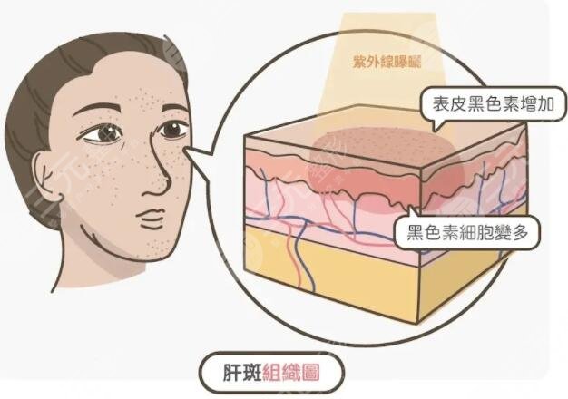 彩光祛斑的費(fèi)用一般多少錢(qián)左右?