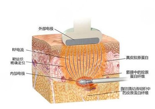 鐳射溶脂有效果嗎？
