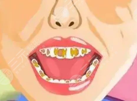 烤瓷牙