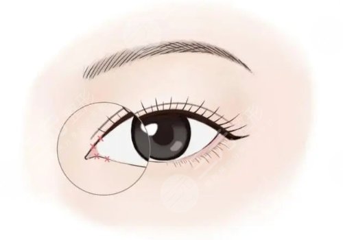 開內(nèi)眼角一般多少錢？