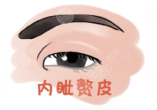開內(nèi)眼角一般多少錢？