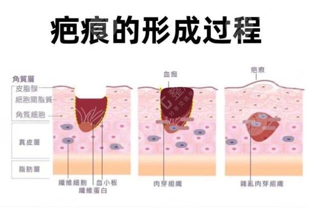 像素激光祛疤的優(yōu)點有哪些?