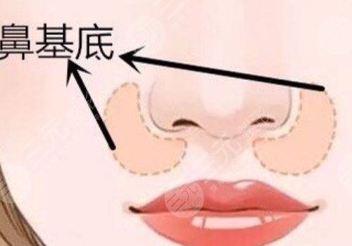 鼻基底注射玻尿酸會移位嗎？