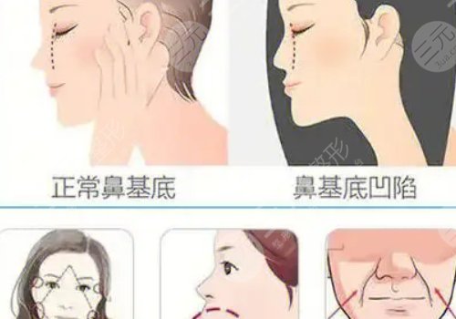 鼻基底注射玻尿酸會移位嗎？