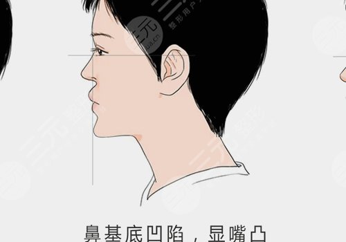 鼻基底注射玻尿酸會移位嗎？